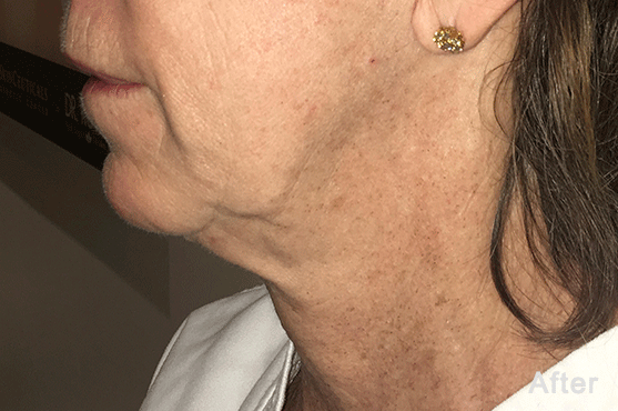 MORPHEUS8 RF MICRONEEDLING