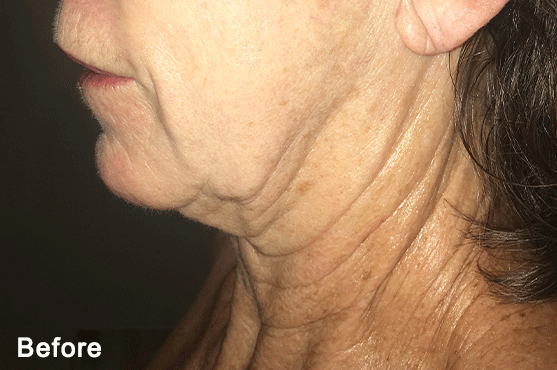 MORPHEUS8 RF MICRONEEDLING